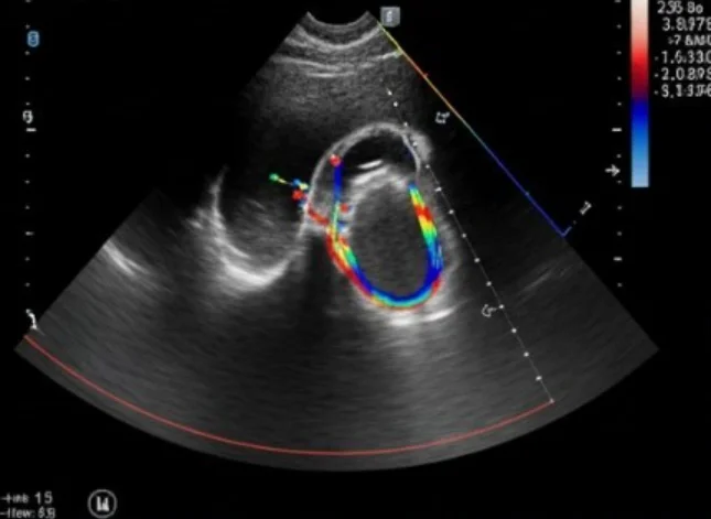 Ecocardiograma com Doppler