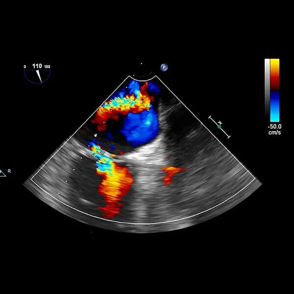 Ecocardiograma com Doppler colorido