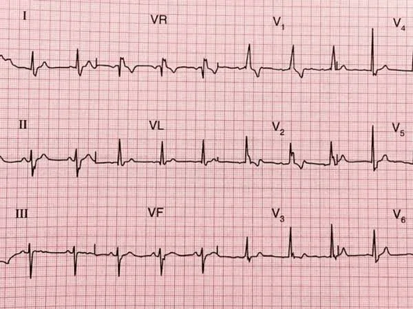 Eletrocardiograma (ECG)